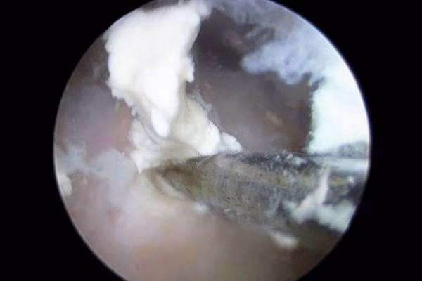 Tendinitis calcificante